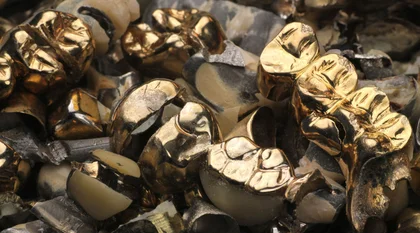 Goldkronen / Dentallegierungen